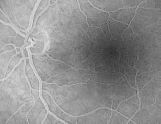 Low Light Retinal Imaging in Fluorescence Angiography