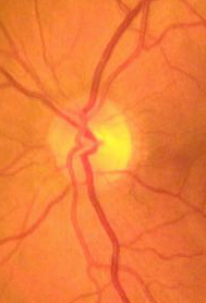 Retinal Imaging Fundus Color and Whitebalancing