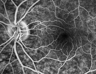 Retinal Imaging Perception of Depth